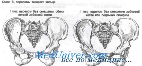 Классификация переломов костей таза