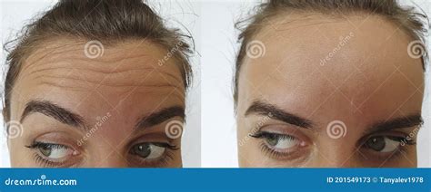 Woman Forehead Wrinkles before and after Treatment Stock Image - Image ...