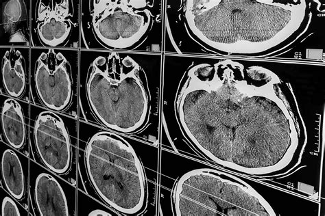 Cómo Puede Ayudarle Un Abogado Especializado En Lesiones Cerebrales De