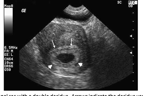 Decidual Reaction Ultrasound