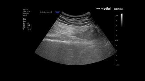 Pudendal Nerve Usg Block Youtube