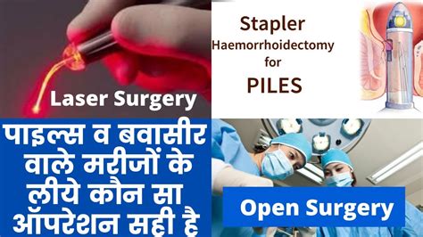 How To Get Relief From Piles Piles Treatment Piles Open Surgery