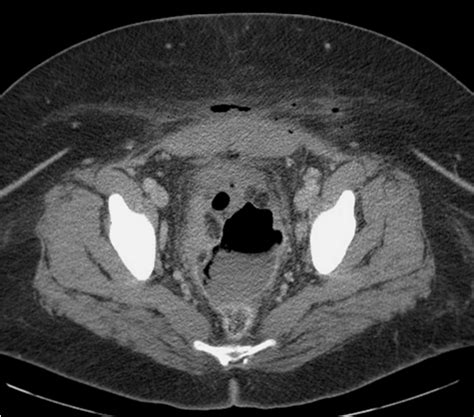 Figure 1 From Endoscopic Ultrasound Guided Transrectal Drainage Of A