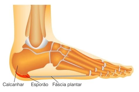 Ondas De Choque Para Espor O E Tendinite Do Tend O Calc Neo Aquiles