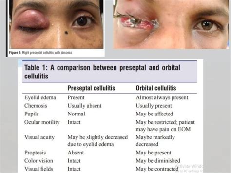 Orbital Cellulitis Adult Treatment