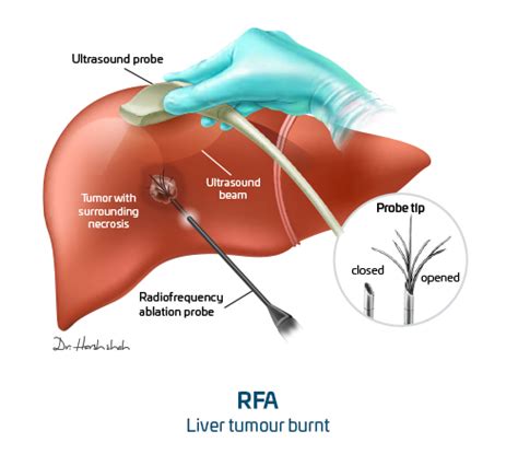 Best Liver Cancer Hospital In Ahmedabad India