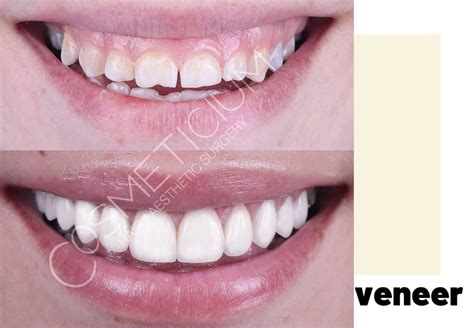 Veneers in Turkey: Affordable Cost Smile Makeover - Cosmeticium