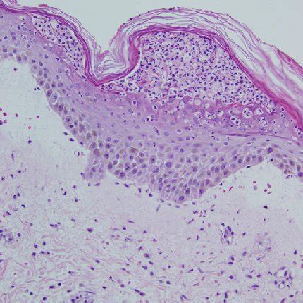 Rickettsia Parkeri Infection Histopathology Of Cutaneous Punch Biopsy