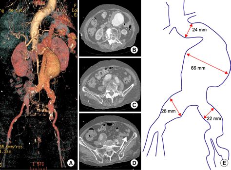 Preoperative Computed Tomography Of Abdominal Aortic Aneurysm Aaa Download Scientific Diagram