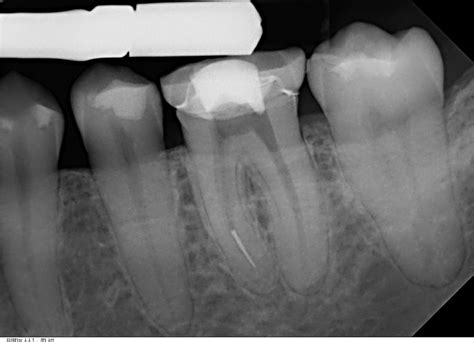 Management Of Broken File In Root Canal At Heath Alejos Blog