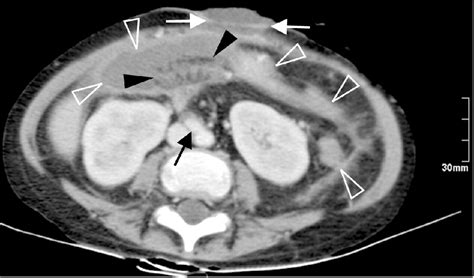 Spectrum Of Imaging Findings After Intestinal Liver Intestinal Or