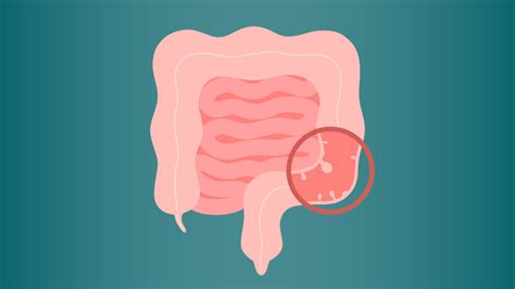 En qué consiste el cribado de cáncer de colon Así se buscan lesiones