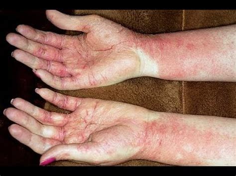 treatment for eczema on hands - pictures, photos