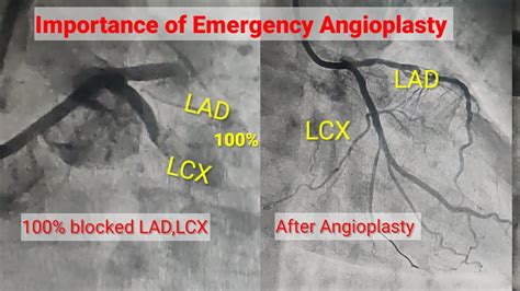 Emergency Angioplasty of 100% Blocked LAD, LCX l Stenting of LAD, LCX l ...