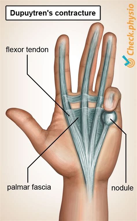 2018-08-21 - hand | dupuytren's contracture disease palmar fascia ...