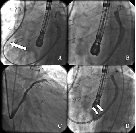 Trans Coronary Venous Interventions Circulation Cardiovascular