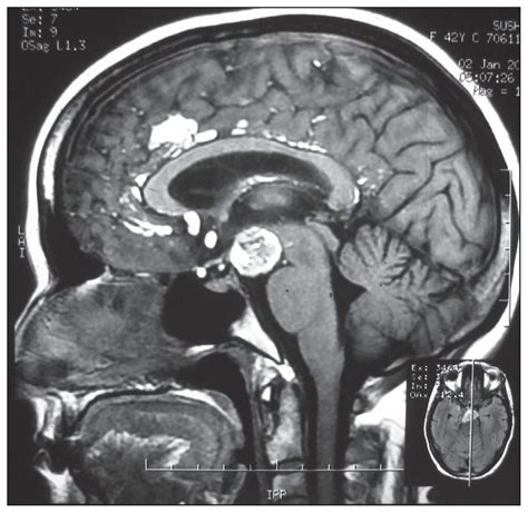 Ruptured Intracranial Dermoid Cyst Annals Of Saudi Medicine