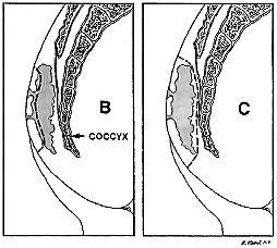 Pilonidal Abscess: Symptoms, Causes, & Treatment | Sinusitis, Pilonidal ...