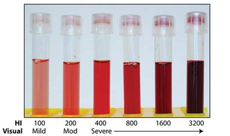 Hemolysis index (HI) versus visual estimates of hemolysis | eClinpath