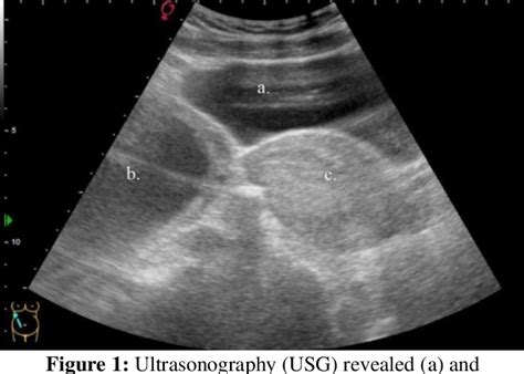 Figure 1 From Pregnancy With Didelphys Uterus And Omphalocele Infant A