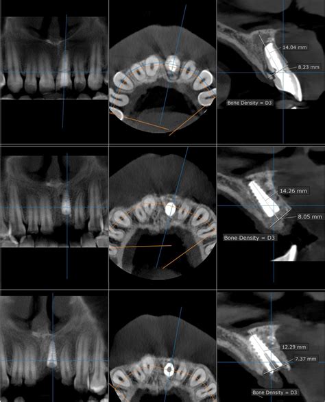 Showing CBCT Before Just After And After Six Months Follow Up Within