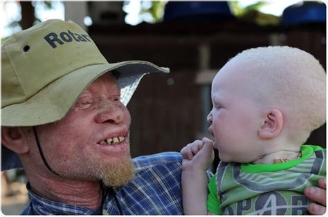 Partial Albinism In Humans