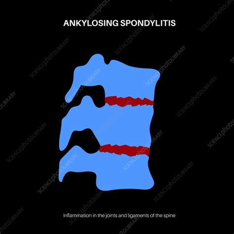 Ankylosing Spondylitis Illustration Stock Image F042 1217 Science Photo Library