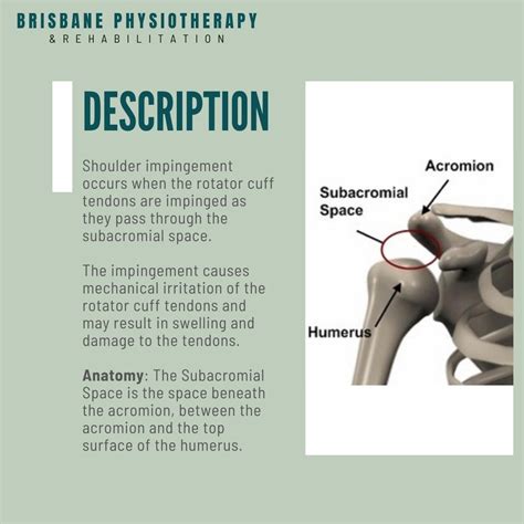 Subacromial Impingement What Is It Symptoms Treatment Exercises Physio Brisbane