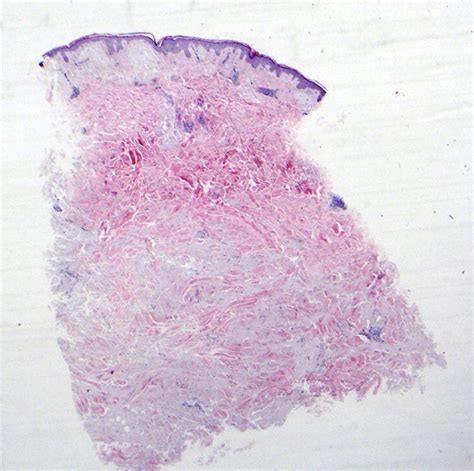 Multiple Lesions Of Primary Cutaneous Nodular Amyloidosis In Sjögren