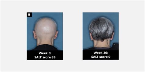 Top Image Fda Approved Drug Hair Loss Thptnganamst Edu Vn