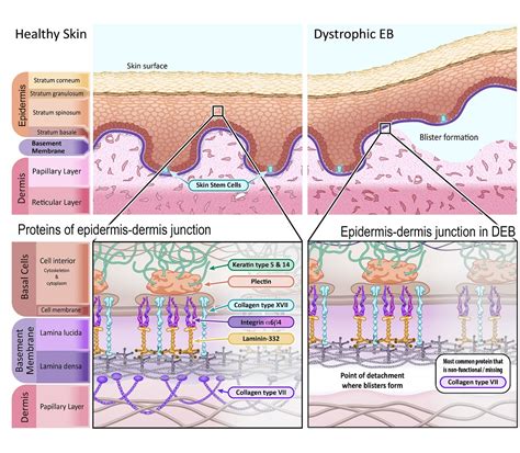 Epidermolysis Bullosa How Could Gene And Cell Therapy Help Eurogct