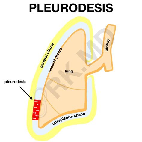 What Is Pleurodesis Rk Md