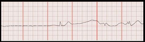 ECG Rhythm Strip Quiz 103