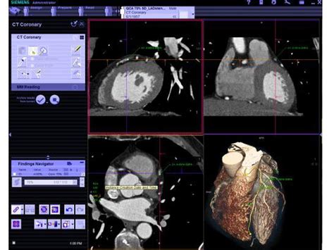 Syngo Ct Coronary Analysis Siemens Healthineers