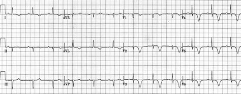 Wellens Syndrome • LITFL • ECG Library Eponym