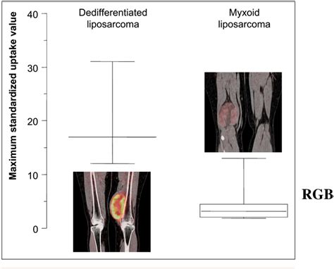 Figure 3 From Correlation Between Glycolytic Phenotype And Tumor Grade