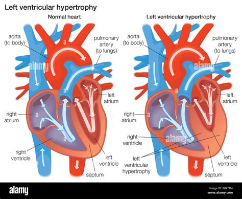 Left Ventricular Posterior Wall