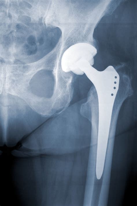 X-ray of an artificial left hip joint of a large human | Sports ...