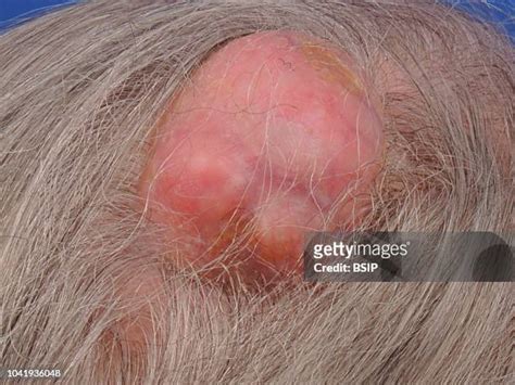 Sebaceous Cyst Scalp