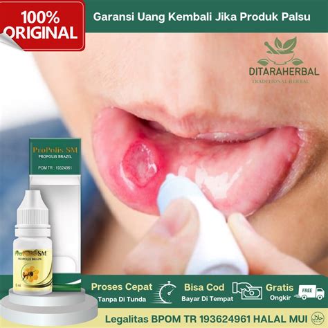 Jual Obat Sariawan Obat Tetes Sariawan Obat Luka Sariawan Obat Oles