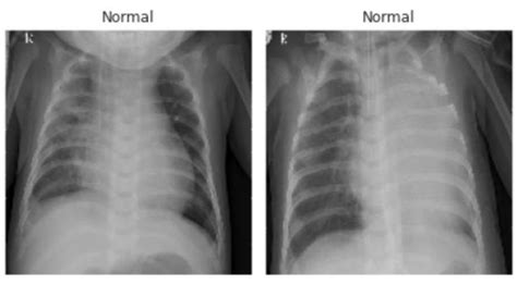 Normal chest X-Ray sample Figure 2 is a sample image with a normal ...