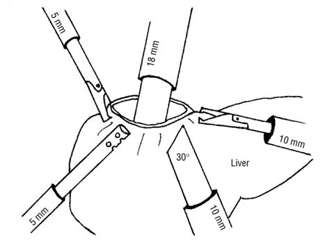 Dr. Harshad Mahatme : Laparoscopic Surgery For Liver Cyst