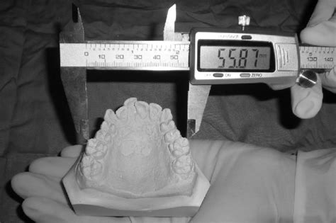 Measurement Of Maxillary Intermolar Width On Study Model Mandibular