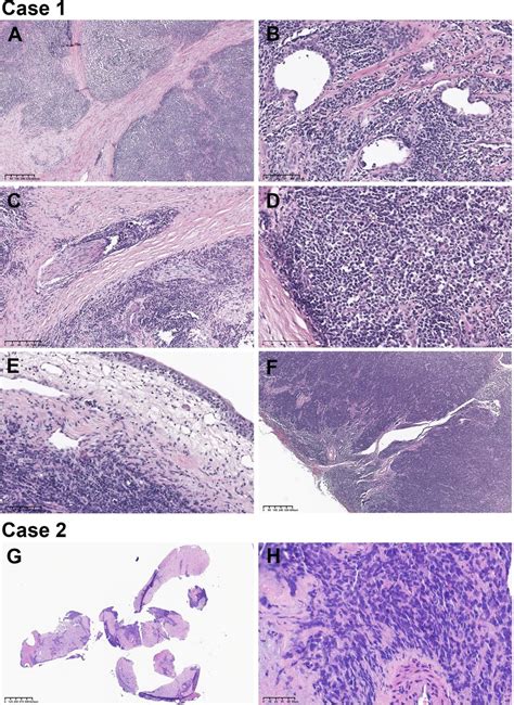 Primary Desmoplastic Small Round Cell Tumour Of The Prostate Journal