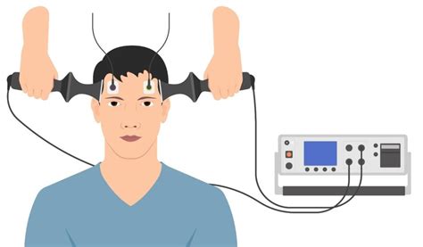 What Is Electroconvulsive Therapy Definition Side Effects