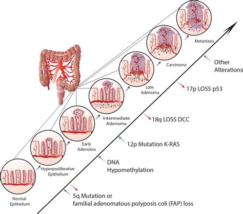 List 94 Pictures Pictures Of Colorectal Cancer Stunning