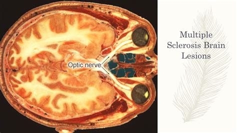 Multiple Sclerosis Skin Lesions: Causes, Symptoms, and Treatment Options