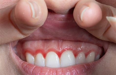 Diferencias Entre La Gingivitis Y La Periodontitis Cl Nica Dental Ana