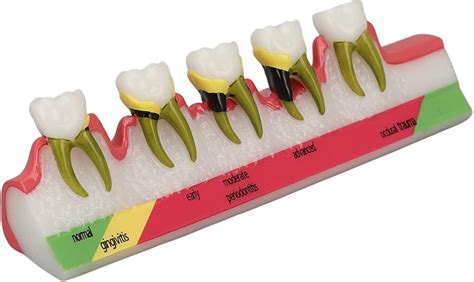 Wie Schnell Schreitet Parodontitis Voran Online Emergencydentistry