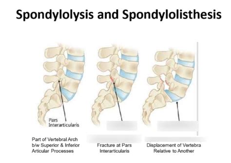 Spine Crack Diagram Quizlet